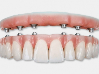 All On 4® / All on 6®